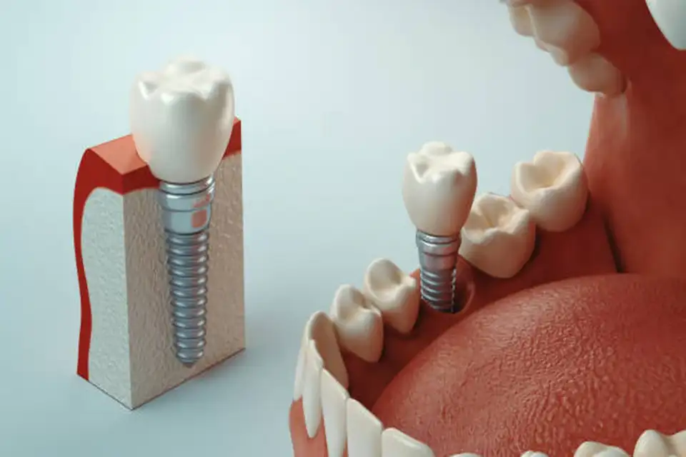 Fixed teeth on implants