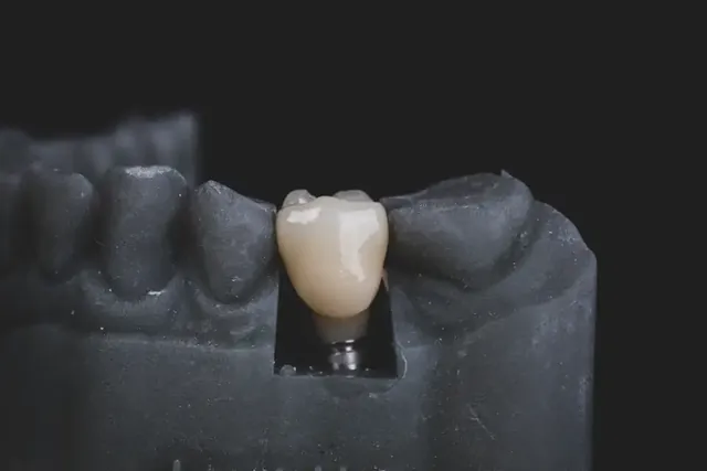 Structure of a dental implant: crown, abutment and implant