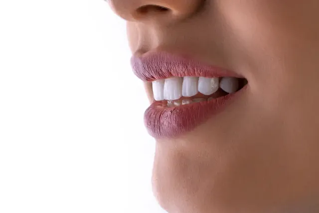 E-max ceramic veneer next to a natural tooth