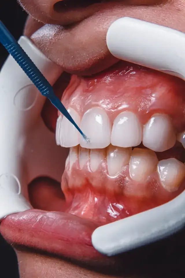 Zirconia crown and a prepared tooth